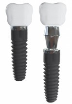  Murales Implante dental